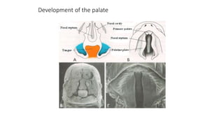 Development of the palate
 