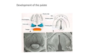 Development of the palate
 