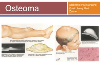 Osteoma Stephanie Paz Manzano Edwin Arney Marín Zarate 