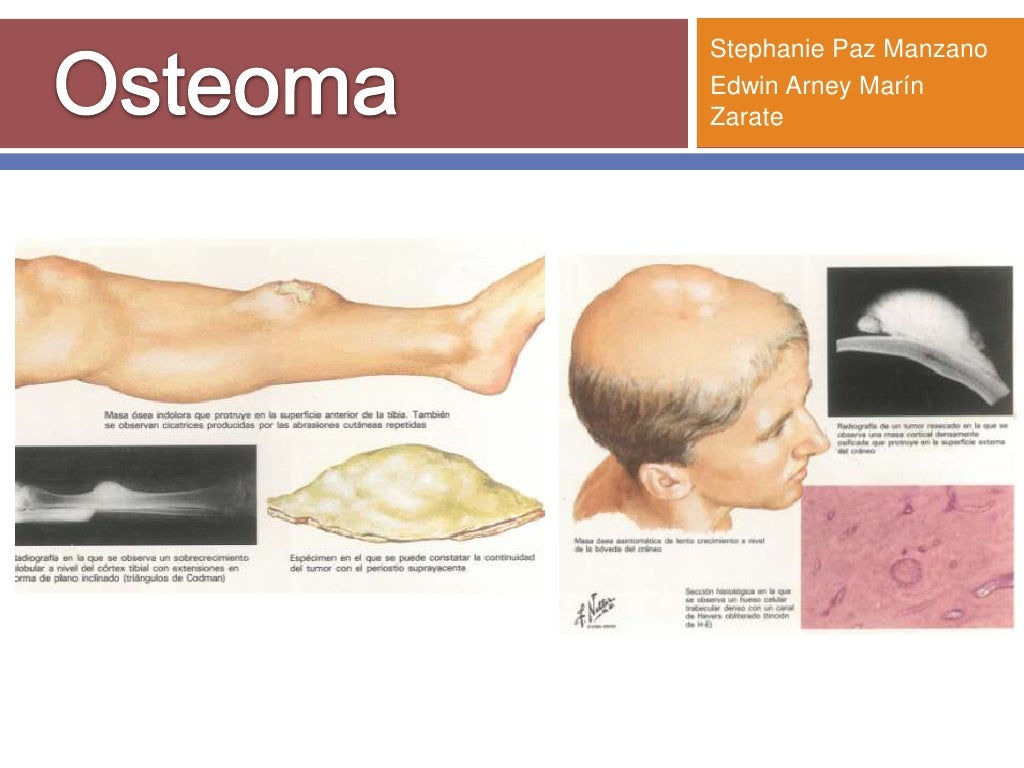 Osteoma