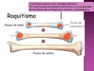 Crecimiento excesivo del cartílago epifisiario
       Por calcificación provisional insuficiente y a la incapacidad
       de las células del cartilago para madurar y desintegrarse


Raquitismo
 