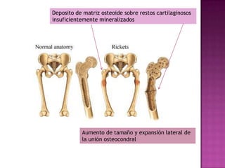 Deposito de matriz osteoide sobre restos cartilaginosos
insuficientemente mineralizados




           Aumento de tamaño y expansión lateral de
           la unión osteocondral
 