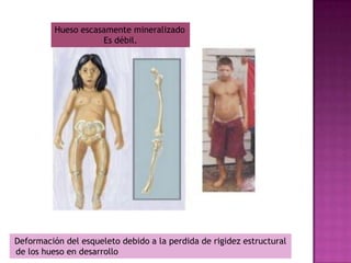 Hueso escasamente mineralizado
                     Es débil.




Deformación del esqueleto debido a la perdida de rigidez estructural
de los hueso en desarrollo
 