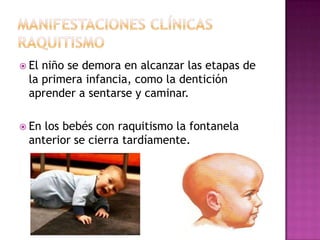  Elniño se demora en alcanzar las etapas de
 la primera infancia, como la dentición
 aprender a sentarse y caminar.

 Enlos bebés con raquitismo la fontanela
 anterior se cierra tardíamente.
 