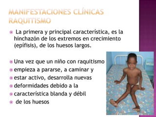     La primera y principal característica, es la
    hinchazón de los extremos en crecimiento
    (epífisis), de los huesos largos.

 Una vez que un niño con raquitismo
 empieza a pararse, a caminar y
 estar activo, desarrolla nuevas
 deformidades debido a la
 característica blanda y débil
 de los huesos
 