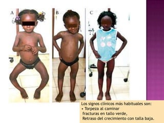 Los signos clínicos más habituales son:
• Torpeza al caminar
 fracturas en tallo verde,
 Retraso del crecimiento con talla baja.
 