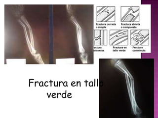 Fractura en tallo
    verde
 