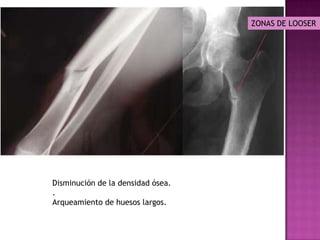ZONAS DE LOOSER




Disminución de la densidad ósea.
.
Arqueamiento de huesos largos.
 