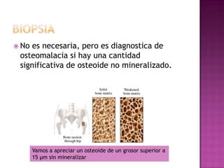  No es necesaria, pero es diagnostica de
 osteomalacia si hay una cantidad
 significativa de osteoide no mineralizado.




       Vamos a apreciar un osteoide de un grosor superior a
       15 μm sin mineralizar
 