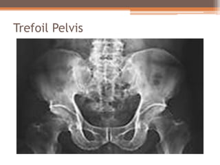 Trefoil Pelvis
 