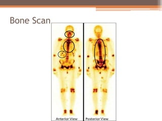Bone Scan
 