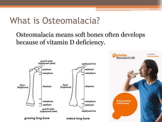 What is Osteomalacia?
Osteomalacia means soft bones often develops
because of vitamin D deficiency.
 