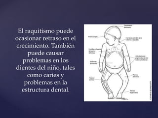 El raquitismo puede
ocasionar retraso en el
crecimiento. También
puede causar
problemas en los
dientes del niño, tales
como caries y
problemas en la
estructura dental.
 