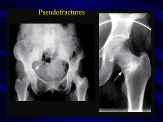 Pseudofractures
 