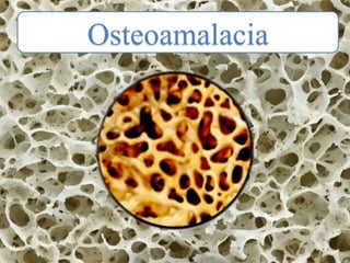 Osteoamalacia
 