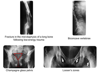 Fracture in the mid-diaphysis of a long bone
following low-energy trauma
Champagne glass pelvis
Biconcave vertebrae
Looser’s zones
 
