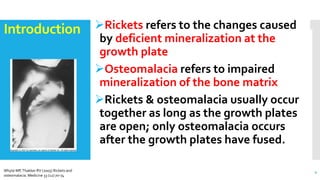Osteomalacia | PPTX