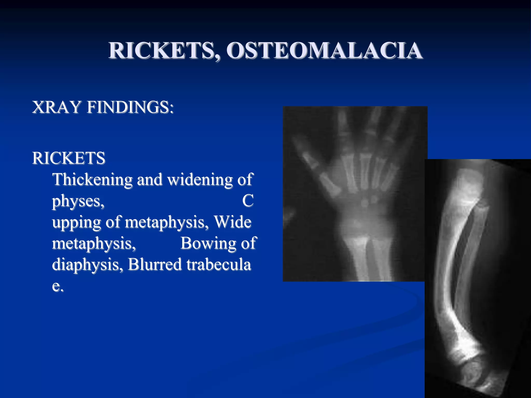 C Rickets Osteomalacia.pptx