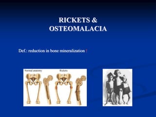 RICKETS &
OSTEOMALACIA
Def.: reduction in bone mineralization !
 