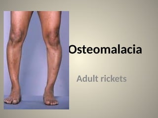 osteomalacia-with-paget-disease-don.pptx