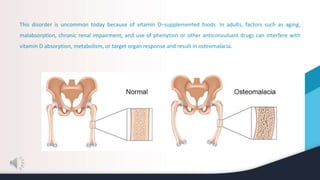 This disorder is uncommon today because of vitamin D–supplemented foods. In adults, factors such as aging,
malabsorption, chronic renal impairment, and use of phenytoin or other anticonvulsant drugs can interfere with
vitamin D absorption, metabolism, or target organ response and result in osteomalacia.
 