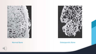 Normal Bone Osteoporotic Bone
 