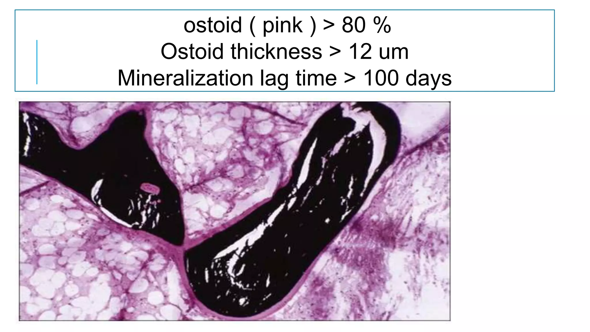 Osteomalacia and rickets | PPTX