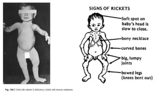 Osteomalacia and rickets | PPTX