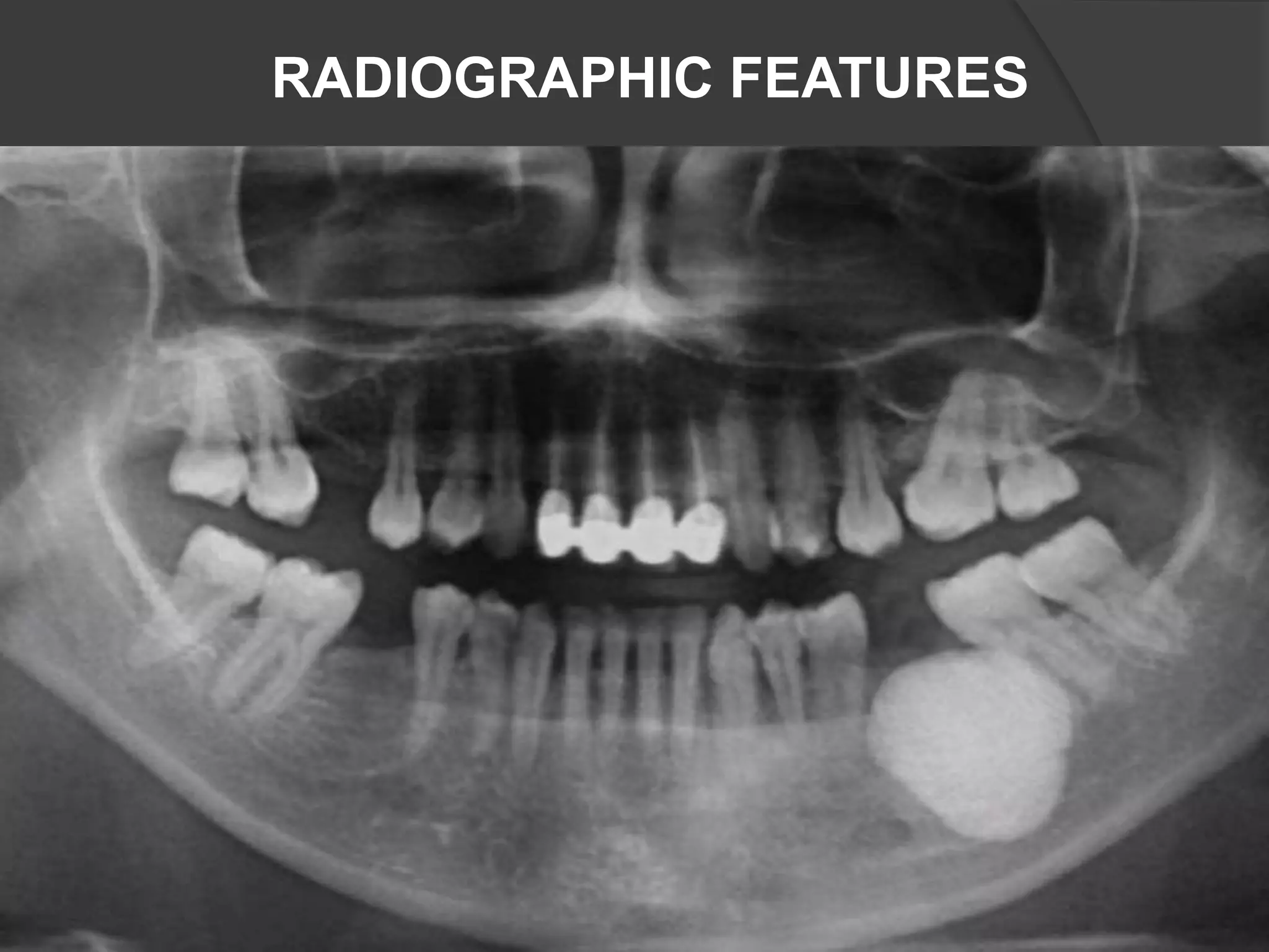 RADIOGRAPHIC FEATURES
 
