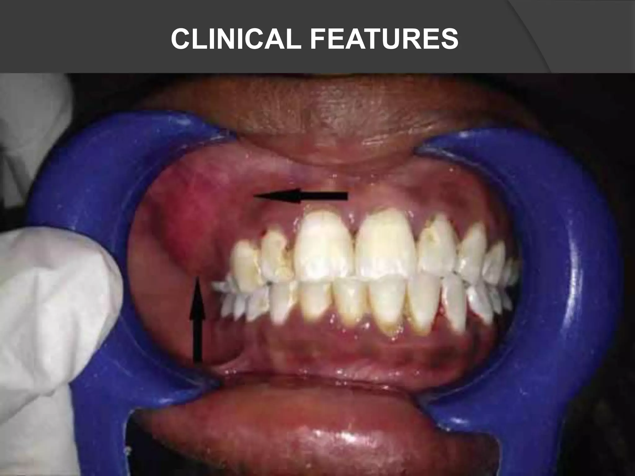 CLINICAL FEATURES
 