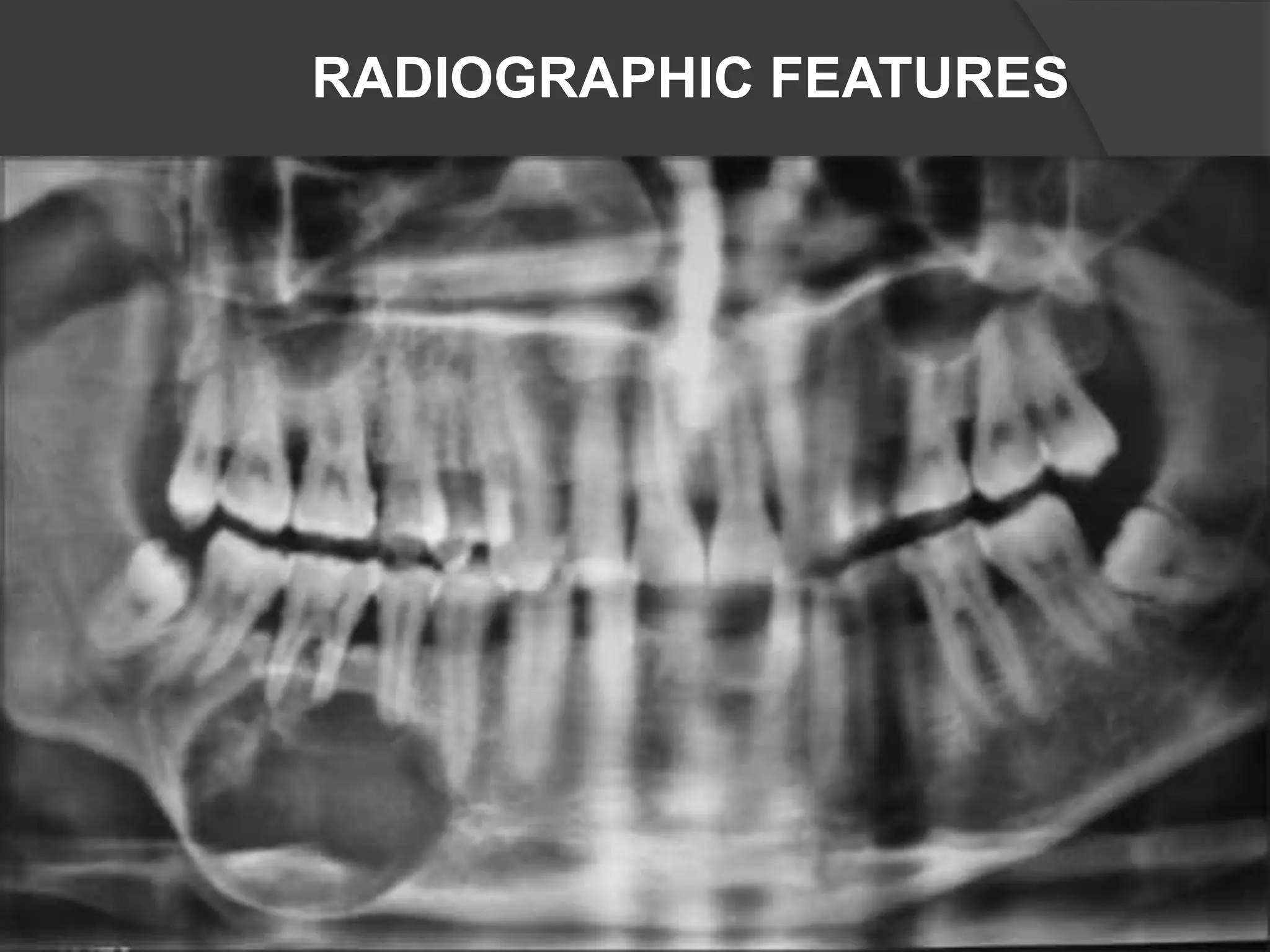 RADIOGRAPHIC FEATURES
 