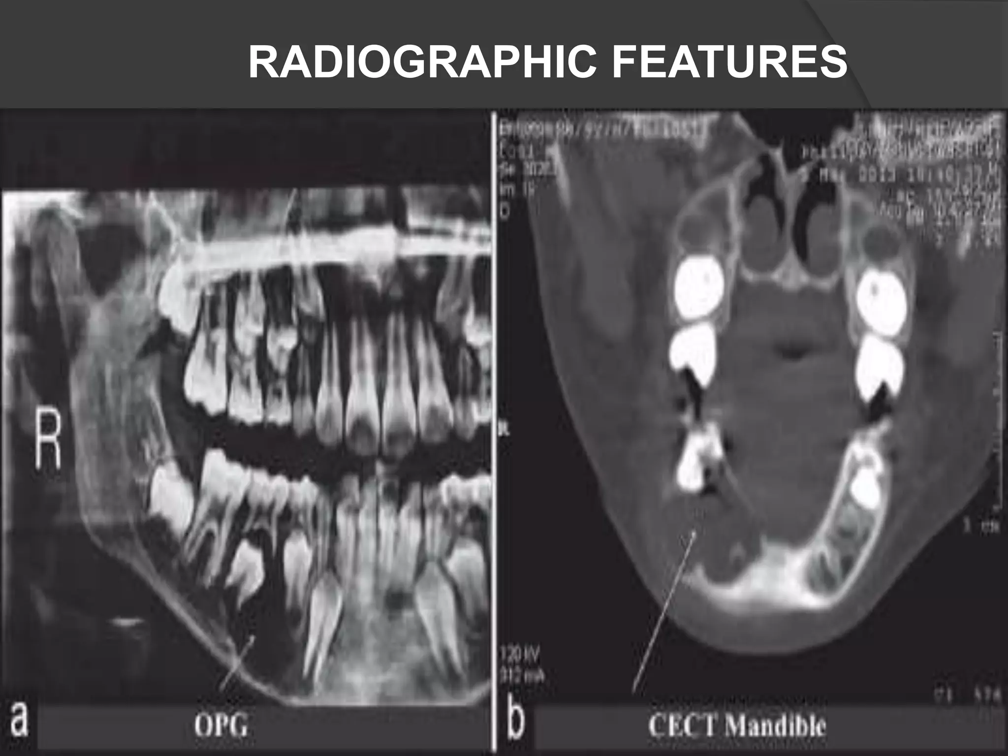 RADIOGRAPHIC FEATURES
 