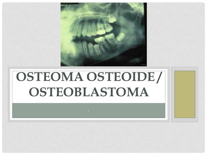 Osteoma osteoide