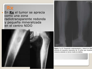 Rx


En Rx el tumor se aprecia
como una zona
radiotransparente redonda
y pequeña mineralizada
en el centro NIDO

 