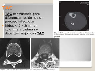 TAC




TAC contrastada para
diferenciar lesión de un
proceso infeccioso
Nidos < 2 - 3mm en
columna y cadera se
detectan mejor con TAC

 