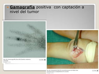 

Gamagrafía positiva con captación a
nivel del tumor

 