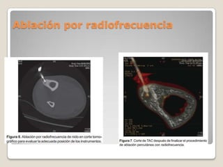 Ablación por radiofrecuencia

 