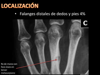 Osteoma osteoide | PPTX