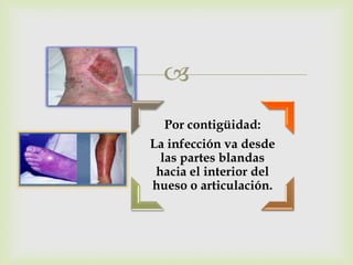 
  Por contigüidad:
La infección va desde
  las partes blandas
 hacia el interior del
hueso o articulación.
 
