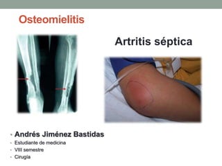 Osteomielitis
• Andrés Jiménez Bastidas
• Estudiante de medicina
• VIII semestre
• Cirugía
Artritis séptica
 