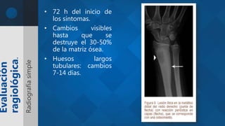 • 72 h del inicio de
los síntomas.
• Cambios visibles
hasta que se
destruye el 30-50%
de la matriz ósea.
• Huesos largos
tubulares: cambios
7-14 días.
Evaluación
ragiológica.
Radiografíasimple
 