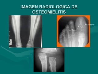IMAGEN RADIOLOGICA DE
IMAGEN RADIOLOGICA DE
OSTEOMIELITIS
OSTEOMIELITIS
Secuestro
Involucro
 