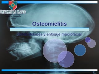 Osteomielitis Generalidades y enfoque maxilofacial 