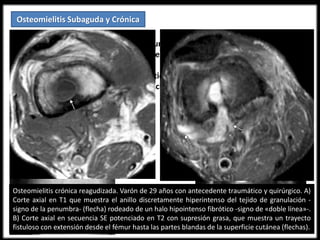Osteomielitis Subaguda y Crónica
- Infección persistente y después de un período de latencia se hacen activas.
- Predilección por metáfisis de los huesos largos.
- Rx simple: Engrosamiento perióstico, reacción ósea esclerótica. Pueden
mostrar involucro y áreas satélites (cloaca).
Osteomielitis crónica reagudizada. Varón de 29 años con antecedente traumático y quirúrgico. A)
Corte axial en T1 que muestra el anillo discretamente hiperintenso del tejido de granulación -
signo de la penumbra- (flecha) rodeado de un halo hipointenso fibrótico -signo de «doble línea»-.
B) Corte axial en secuencia SE potenciado en T2 con supresión grasa, que muestra un trayecto
fistuloso con extensión desde el fémur hasta las partes blandas de la superficie cutánea (flechas).
 