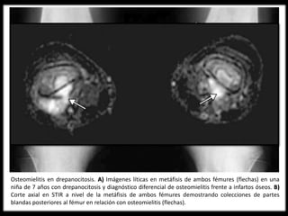 Osteomielitis en la Drepanocitosis
Son más susceptibles a Osteomielitis debido a:
- Asplenia - Opsoninas defectuosas - Infartos óseos
Frecuentemente afecta a Húmero, Fémur y Tibia.
Se afecta más la diáfisis que la metáfisis.
Etiología: Staphylococcus aureus y Salmonella.
Dx: Por biopsia o aspiración ósea combinada con técnicas de imagen.
Osteomielitis en drepanocitosis. A) Imágenes líticas en metáfisis de ambos fémures (flechas) en una
niña de 7 años con drepanocitosis y diagnóstico diferencial de osteomielitis frente a infartos óseos. B)
Corte axial en STIR a nivel de la metáfisis de ambos fémures demostrando colecciones de partes
blandas posteriores al fémur en relación con osteomielitis (flechas).
 