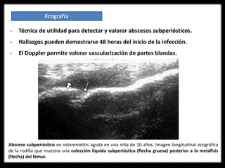 Ecografía
- Técnica de utilidad para detectar y valorar abscesos subperiósticos.
- Hallazgos pueden demostrarse 48 horas del inicio de la infección.
- El Doppler permite valorar vascularización de partes blandas.
Absceso subperióstico en osteomielitis aguda en una niña de 10 años. Imagen longitudinal ecográfica
de la rodilla que muestra una colección líquida subperióstica (flecha gruesa) posterior a la metáfisis
(flecha) del fémur.
 