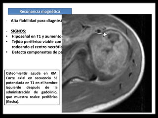 Resonancia magnética
- Alta fiabilidad para diagnóstico de Osteomielitis.
- SIGNOS:
• Hiposeñal en T1 y aumento de señal en T2 y STIR.
• Tejido periférico viable con realce con Gadolinio en T1 y supresión de grasa
rodeando el centro necrótico
• Detecta componentes de partes blandas.
Osteomielitis aguda en RM.
Corte axial en secuencia SE
potenciada en T1 en el hombro
izquierdo después de la
administración de gadolinio,
que muestra realce periférico
(flecha).
 