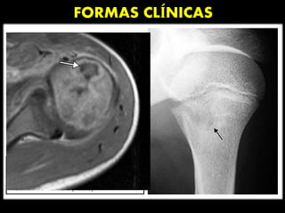 FORMAS CLÍNICAS
Osteomielitis Aguda
Osteomielitis aguda en un niño de 8 años.
Radiología simple del hombro izquierdo que
muestra un foco lítico mal delimitado en la
metáfisis del húmero (flecha).
- Mala delimitación entre los tejidos
de partes blandas debido al edema.
 