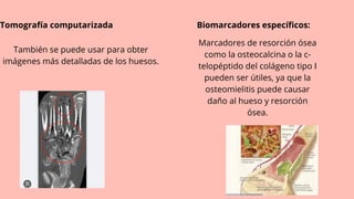 Tomografía computarizada Biomarcadores específicos:
También se puede usar para obter
imágenes más detalladas de los huesos.
Marcadores de resorción ósea
como la osteocalcina o la c-
telopéptido del colágeno tipo I
pueden ser útiles, ya que la
osteomielitis puede causar
daño al hueso y resorción
ósea.
 