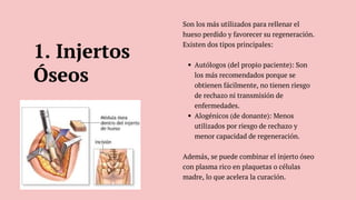 Son los más utilizados para rellenar el
hueso perdido y favorecer su regeneración.
Existen dos tipos principales:
Autólogos (del propio paciente): Son
los más recomendados porque se
obtienen fácilmente, no tienen riesgo
de rechazo ni transmisión de
enfermedades.
Alogénicos (de donante): Menos
utilizados por riesgo de rechazo y
menor capacidad de regeneración.
Además, se puede combinar el injerto óseo
con plasma rico en plaquetas o células
madre, lo que acelera la curación.
1. Injertos
Óseos
 